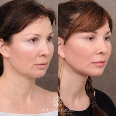 Beverly Hills Center Female Patient Before and After CUPID LIFT® Lip Lift