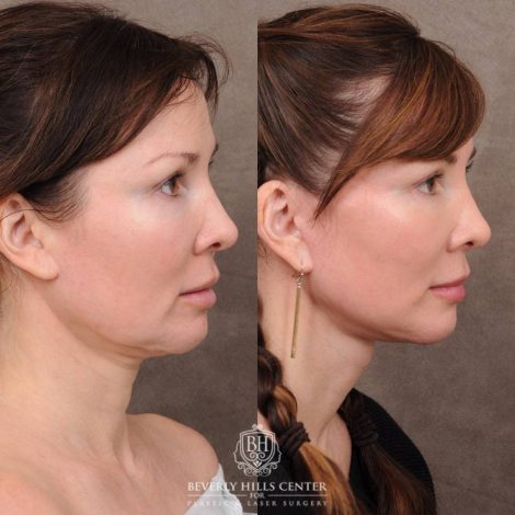 Beverly Hills Center Female Patient Before and After CUPID LIFT® Lip Lift