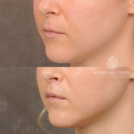 Beverly Hills Center Female Patient Before and After CUPID LIFT® Corner Lift