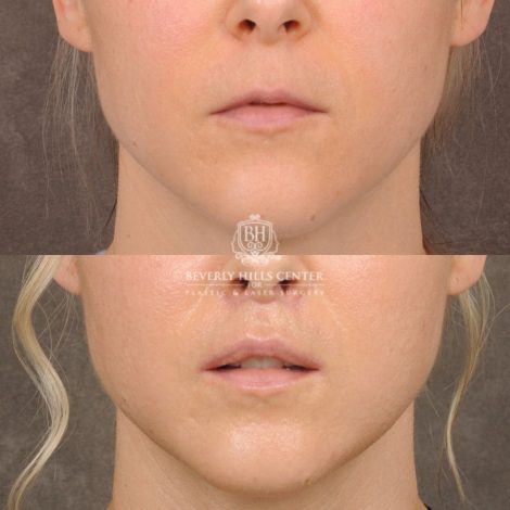 Beverly Hills Center Female Patient Before and After CUPID LIFT® Corner Lift