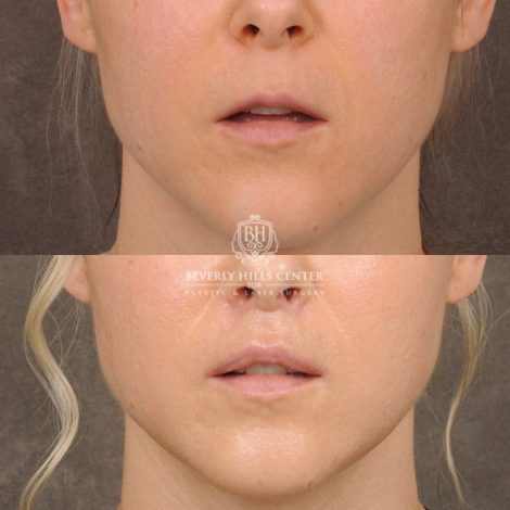 Beverly Hills Center Female Patient Before and After CUPID LIFT® Corner Lift