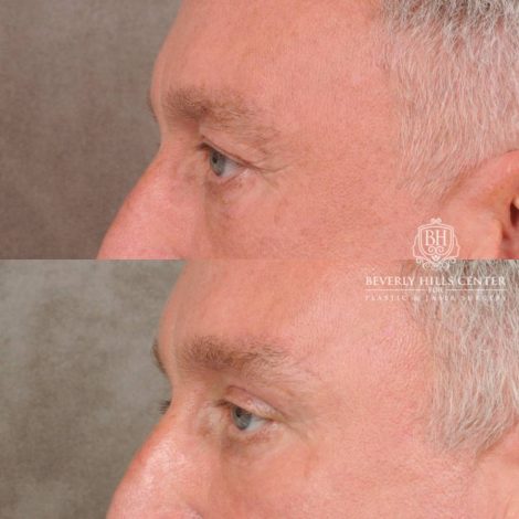 Beverly Hills Center Female Patient Before and After Brow Lift, Upper Blepharoplasty, CO2, and Fat Grafting