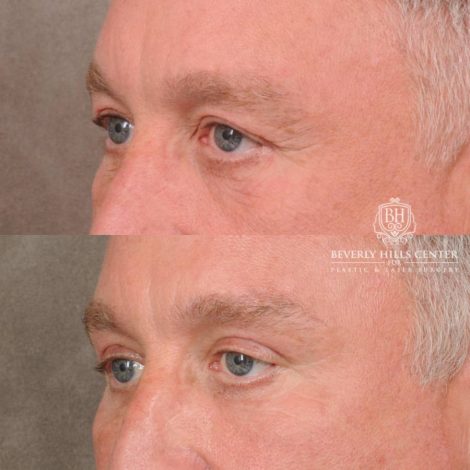 Beverly Hills Center Female Patient Before and After Brow Lift, Upper Blepharoplasty, CO2, and Fat Grafting