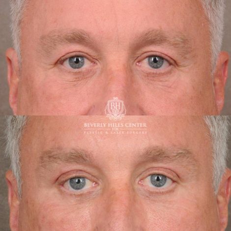 Beverly Hills Center Female Patient Before and After Brow Lift, Upper Blepharoplasty, CO2, and Fat Grafting