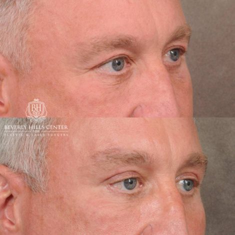 Beverly Hills Center Female Patient Before and After Brow Lift, Upper Blepharoplasty, CO2, and Fat Grafting