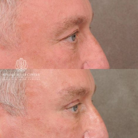 Beverly Hills Center Female Patient Before and After Brow Lift, Upper Blepharoplasty, CO2, and Fat Grafting