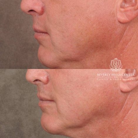 Beverly Hills Center Female Patient Before and After CUPID LIFT® Corner Lift