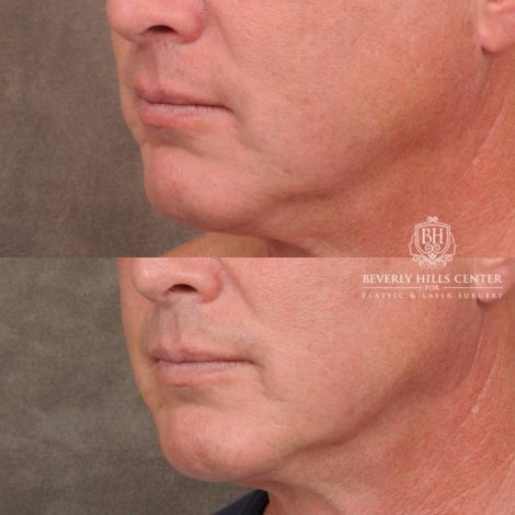 Beverly Hills Center Female Patient Before and After CUPID LIFT® Corner Lift