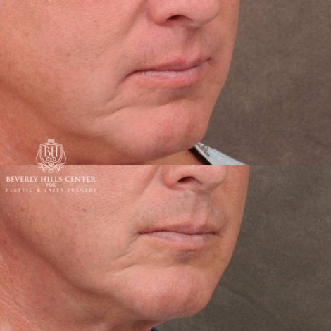 Beverly Hills Center Female Patient Before and After CUPID LIFT® Corner Lift