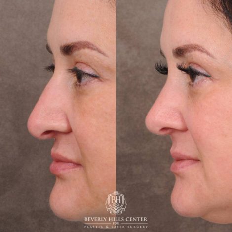 Beverly Hills Center Female Patient Before and After Rhinoplasty, Profound RF