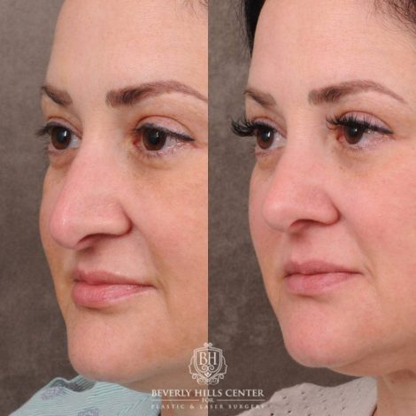 Beverly Hills Center Female Patient Before and After Rhinoplasty, Profound RF