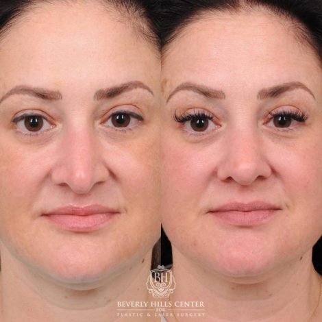 Beverly Hills Center Female Patient Before and After Rhinoplasty, Profound RF
