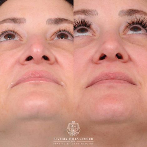 Beverly Hills Center Female Patient Before and After Rhinoplasty, Profound RF