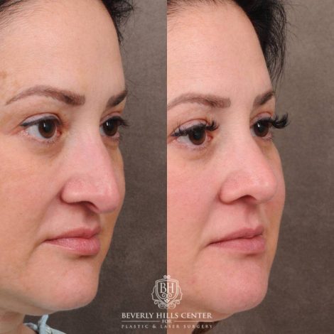 Beverly Hills Center Female Patient Before and After Rhinoplasty, Profound RF