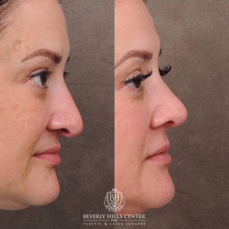 Beverly Hills Center Female Patient Before and After Rhinoplasty, Profound RF
