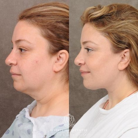 Beverly Hills Center Female Patient Before and After Auralyft, CUPID LIFT® Lip Lift, Upper Blepharoplasty
