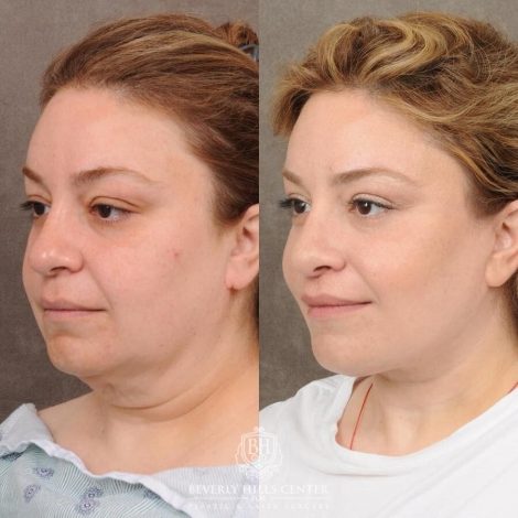 Beverly Hills Center Female Patient Before and After Auralyft, CUPID LIFT® Lip Lift, Upper Blepharoplasty