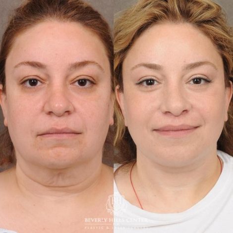 Beverly Hills Center Female Patient Before and After Auralyft, CUPID LIFT® Lip Lift, Upper Blepharoplasty