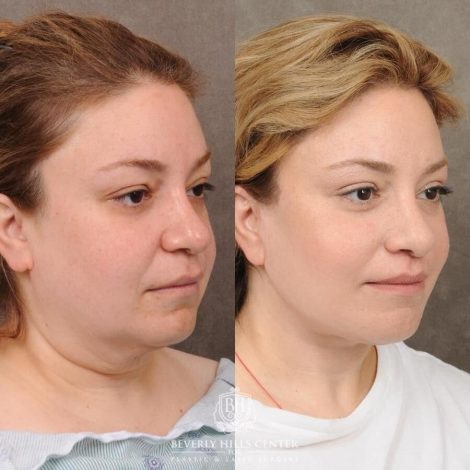 Beverly Hills Center Female Patient Before and After Auralyft, CUPID LIFT® Lip Lift, Upper Blepharoplasty
