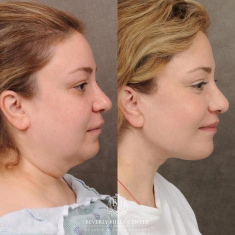 Beverly Hills Center Female Patient Before and After Auralyft, CUPID LIFT® Lip Lift, Upper Blepharoplasty