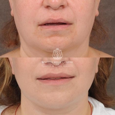 Beverly Hills Center Female Patient Before and After Auralyft, CUPID LIFT® Lip Lift, Upper Blepharoplasty