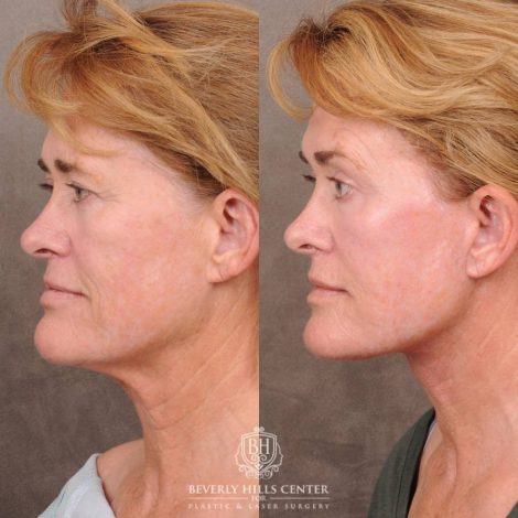Beverly Hills Center Female Patient Before and After AuraLyft, CUPID LIFT® Corner Lift with Fat Grafting & CO2