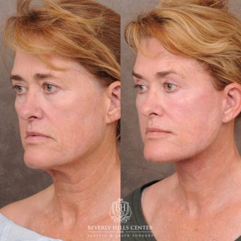 Beverly Hills Center Female Patient Before and After AuraLyft, CUPID LIFT® Corner Lift with Fat Grafting & CO2
