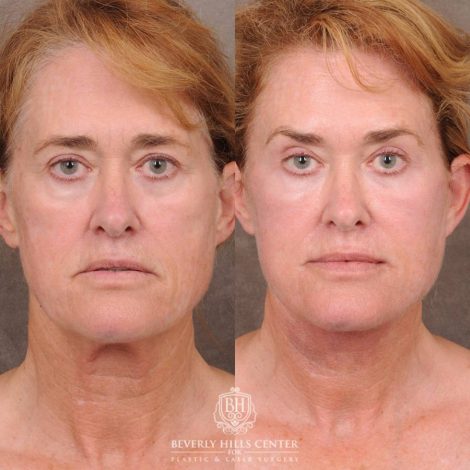 Beverly Hills Center Female Patient Before and After AuraLyft, CUPID LIFT® Corner Lift with Fat Grafting & CO2