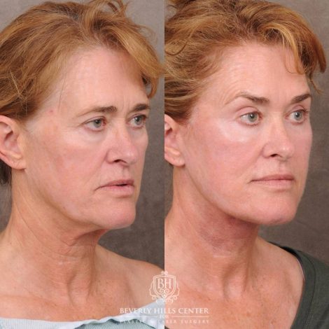 Beverly Hills Center Female Patient Before and After AuraLyft, CUPID LIFT® Corner Lift with Fat Grafting & CO2