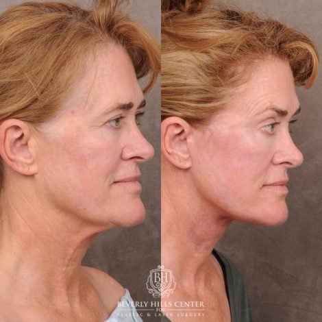 Beverly Hills Center Female Patient Before and After AuraLyft, CUPID LIFT® Corner Lift with Fat Grafting & CO2