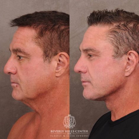 Beverly Hills Center Female Patient Before and After Comprehensive AuraLyft