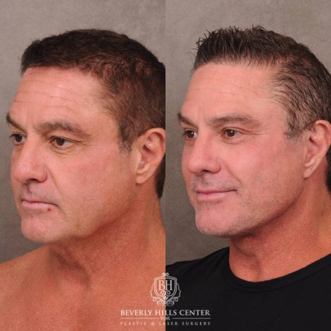 Beverly Hills Center Female Patient Before and After Comprehensive AuraLyft