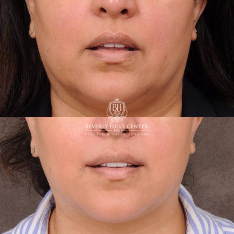 Beverly Hills Center Female Patient Before and After CUPID LIFT® Corner Lift