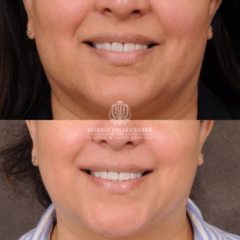 Beverly Hills Center Female Patient Before and After CUPID LIFT® Corner Lift