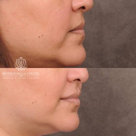 Beverly Hills Center Female Patient Before and After CUPID LIFT® Corner Lift