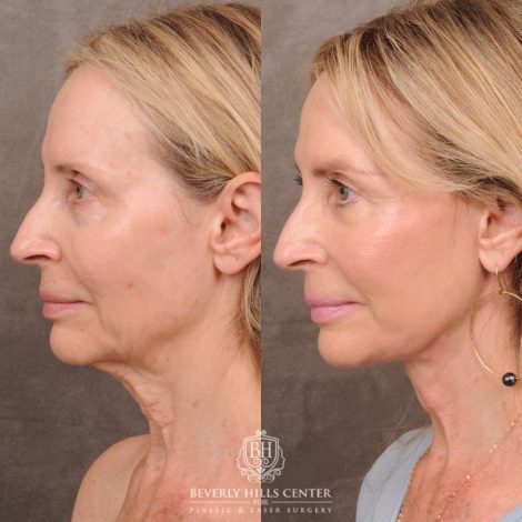 Beverly Hills Center Female Patient Before and After AuraLyft