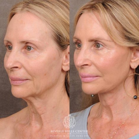 Beverly Hills Center Female Patient Before and After AuraLyft