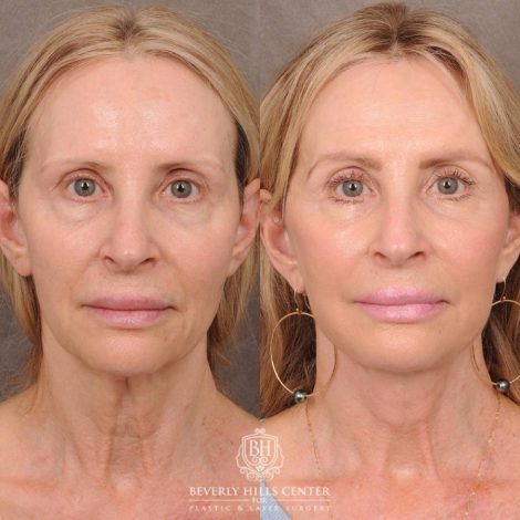 Beverly Hills Center Female Patient Before and After AuraLyft