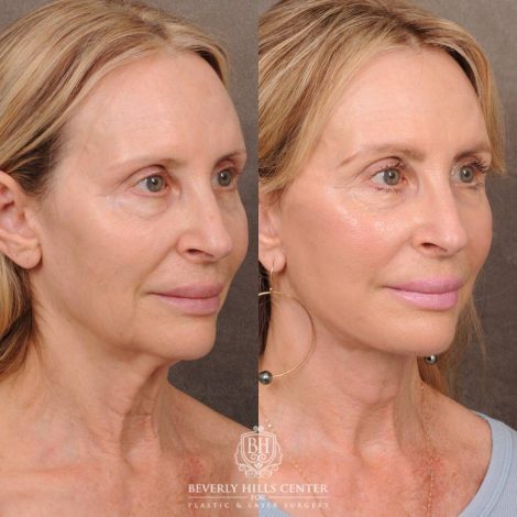 Beverly Hills Center Female Patient Before and After AuraLyft