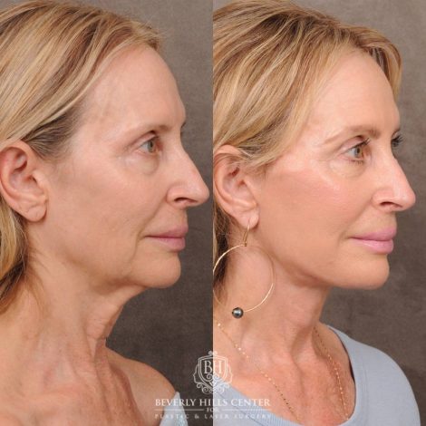 Beverly Hills Center Female Patient Before and After AuraLyft