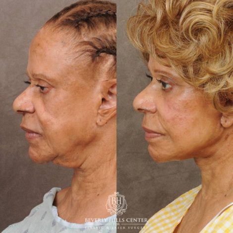 Beverly Hills Center Female Patient Before and After Auralyft Revision with Fat Grafting