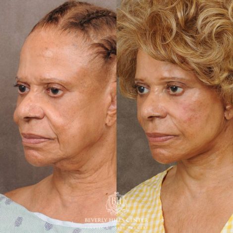 Beverly Hills Center Female Patient Before and After Auralyft Revision with Fat Grafting