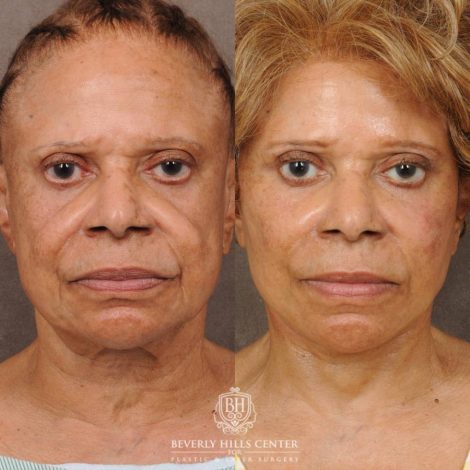 Beverly Hills Center Female Patient Before and After Auralyft Revision with Fat Grafting