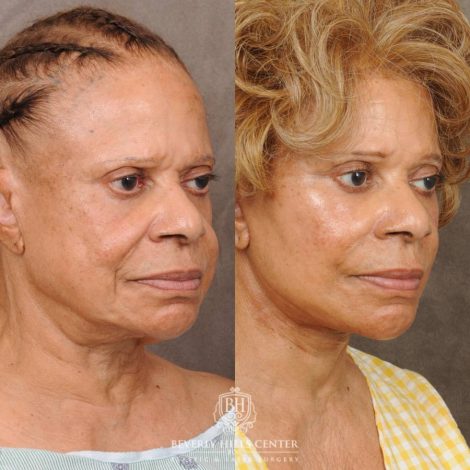 Beverly Hills Center Female Patient Before and After Auralyft Revision with Fat Grafting