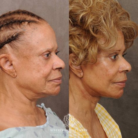 Beverly Hills Center Female Patient Before and After Auralyft Revision with Fat Grafting