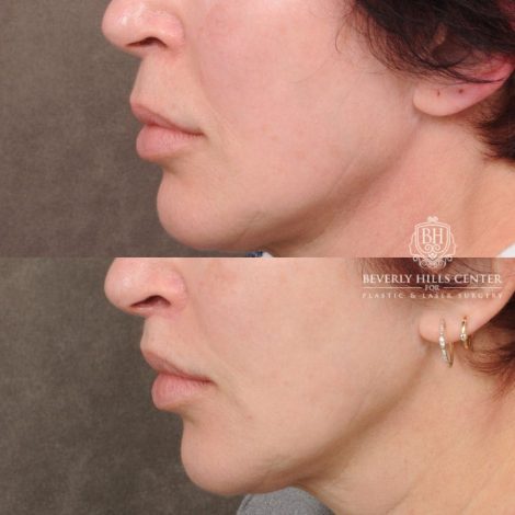 Beverly Hills Center Female Patient Before and After CUPID LIFT® Lip Lift