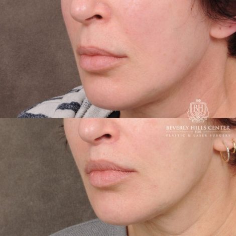 Beverly Hills Center Female Patient Before and After CUPID LIFT® Lip Lift