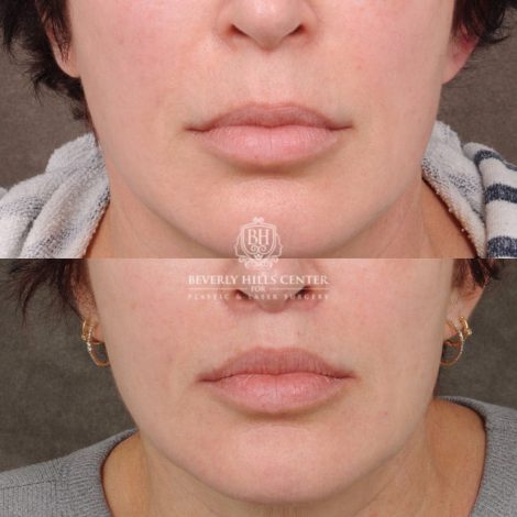 Beverly Hills Center Female Patient Before and After CUPID LIFT® Lip Lift