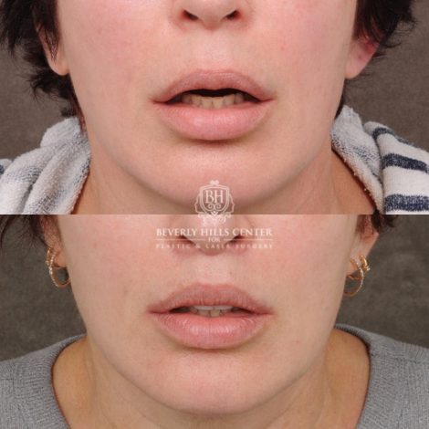 Beverly Hills Center Female Patient Before and After CUPID LIFT® Lip Lift