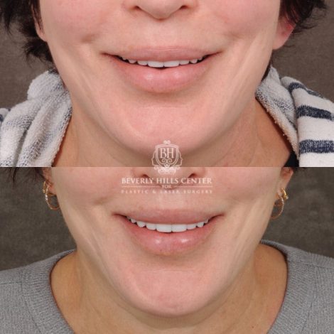 Beverly Hills Center Female Patient Before and After CUPID LIFT® Lip Lift